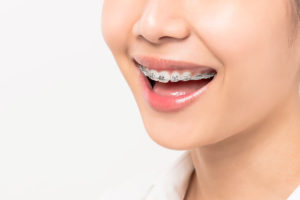 face of a young smiling asian woman with braces on K54Y9DC