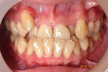 牙齒矯正案例1 1