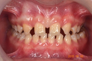 牙齒矯正案例2 1