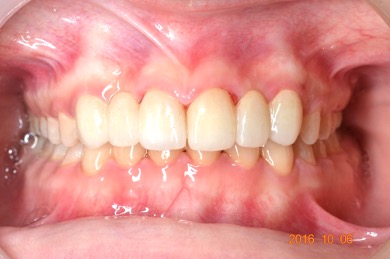 牙齒矯正案例2 2