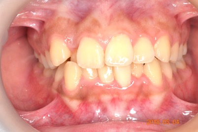 牙齒矯正案例3 1
