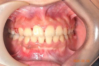 牙齒矯正案例3 2