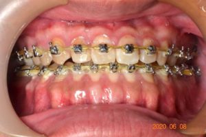 牙齒矯正案例4 1