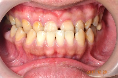 牙齒矯正案例4 2