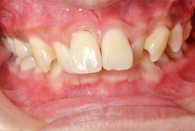 牙齒矯正案例5 1