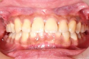 牙齒矯正案例5 2