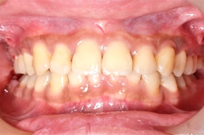 牙齒矯正案例5 2