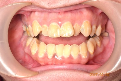 牙齒矯正案例6 1
