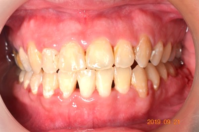 牙齒矯正案例6 2